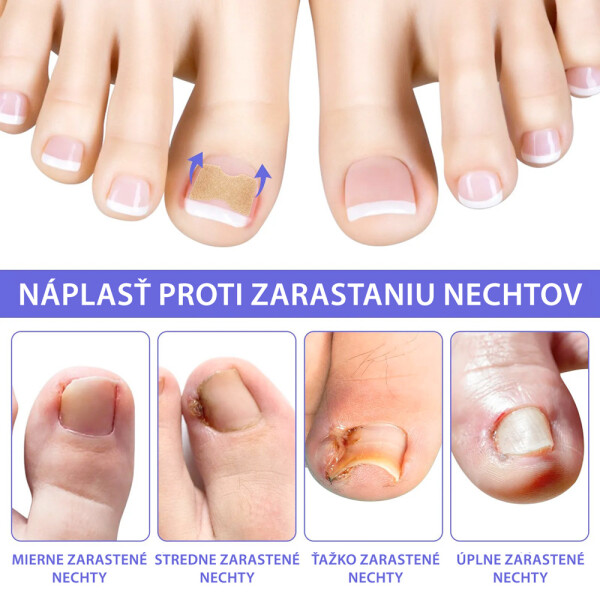 naplasti-nehty-1_2.jpg
